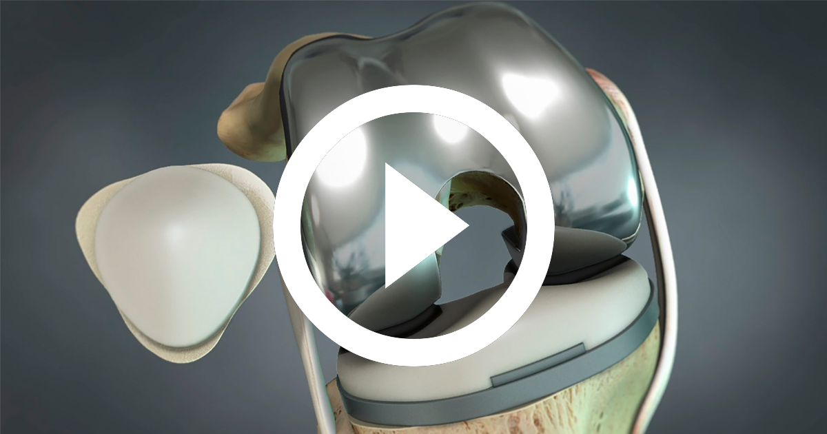 (Video) Cuidados de la prótesis de rodilla