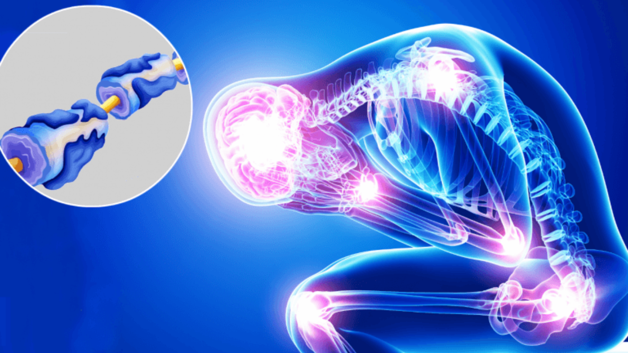 Morelos, libre de Síndrome de Guillain-Barré