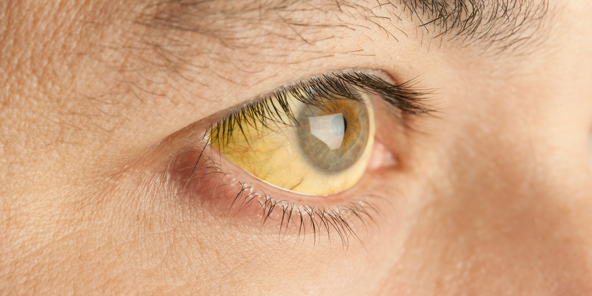La hepatitis se caracteriza por ojos y piel amarillenta. 