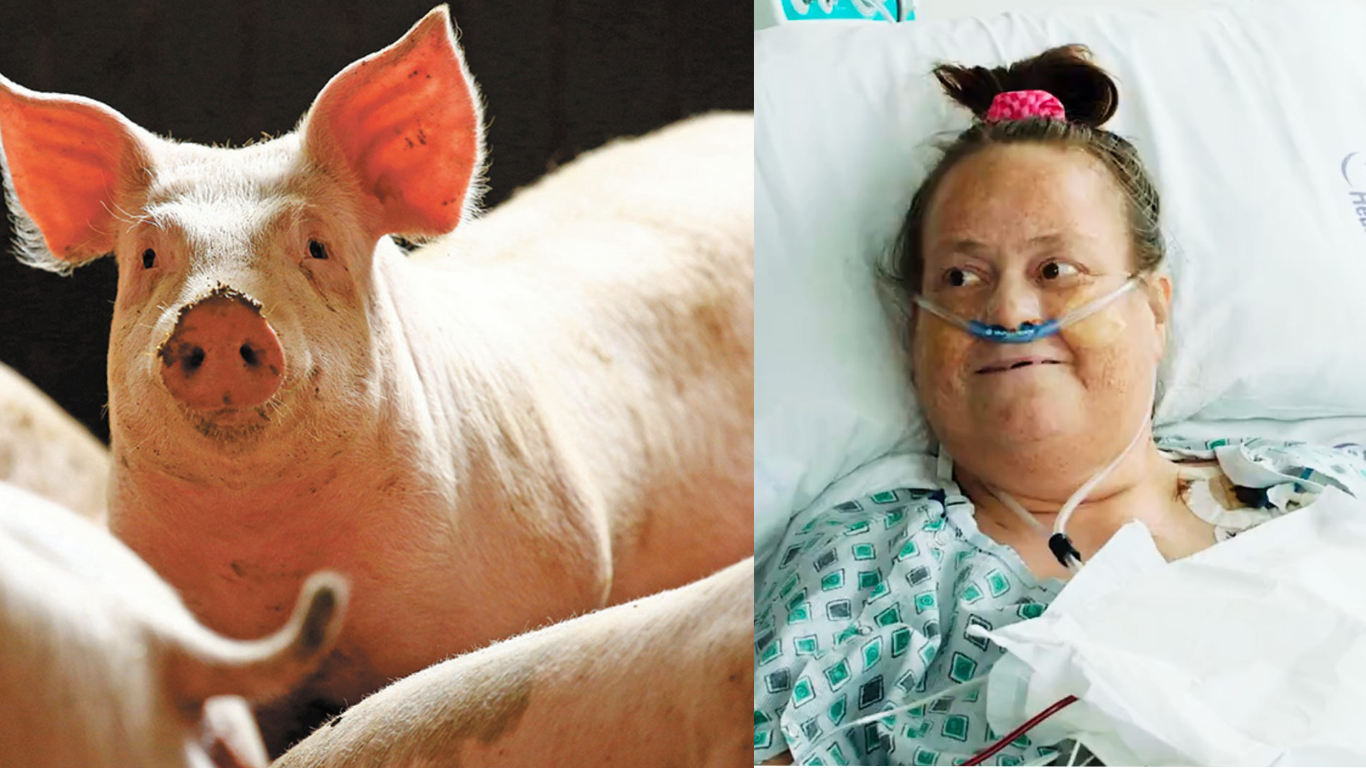 Mujer fallece tras recibir trasplante de un riñón de cerdo