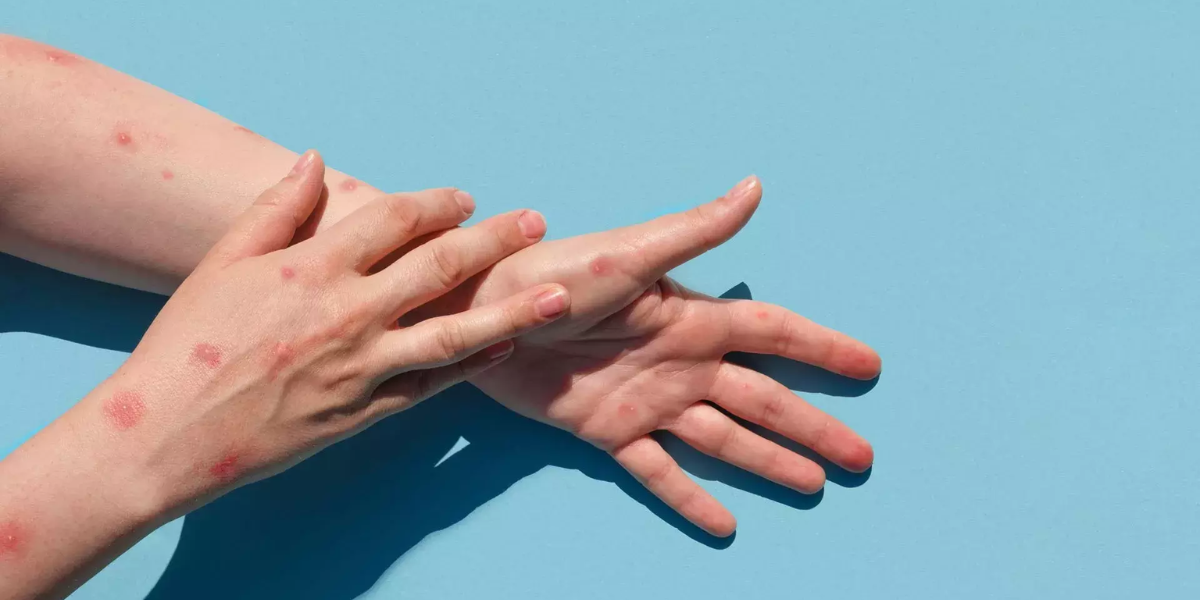 Las lesiones en la piel, síntoma característico de la viruela del mono.