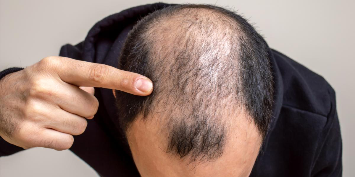 Los problemas de calvicie tiene un factor genético: UNAM.