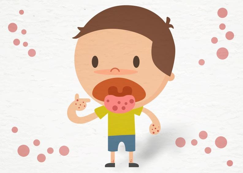 Llama Secretaría de Salud a no alarmarse por Coxsackie