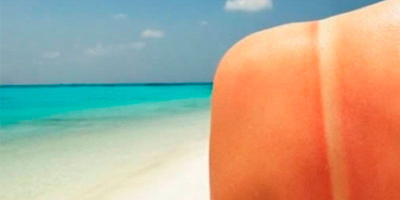 Aguas con las quemaduras por el sol