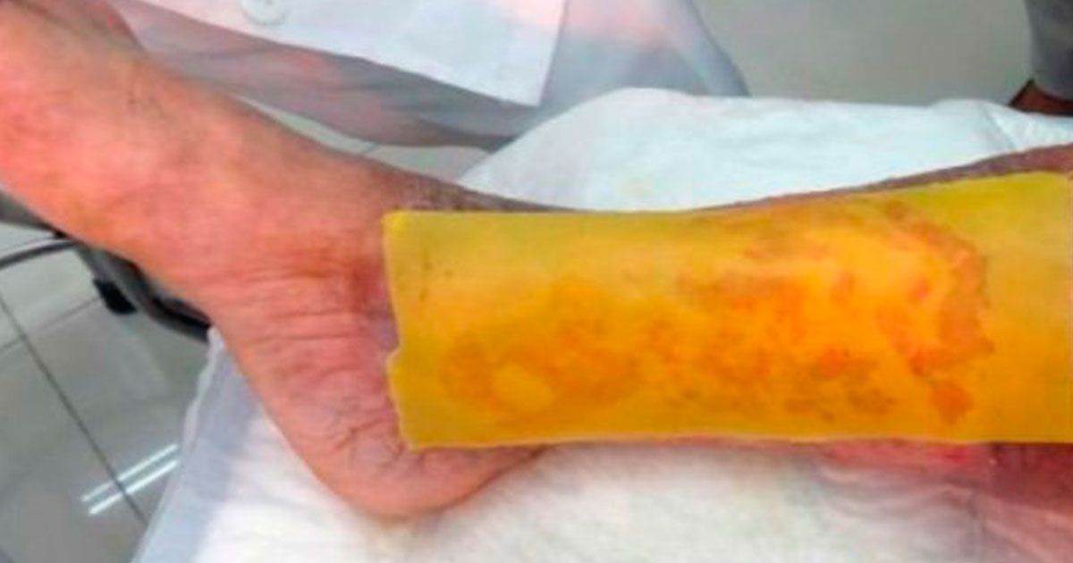 Crean parche que evita amputaciones en pacientes diabéticos