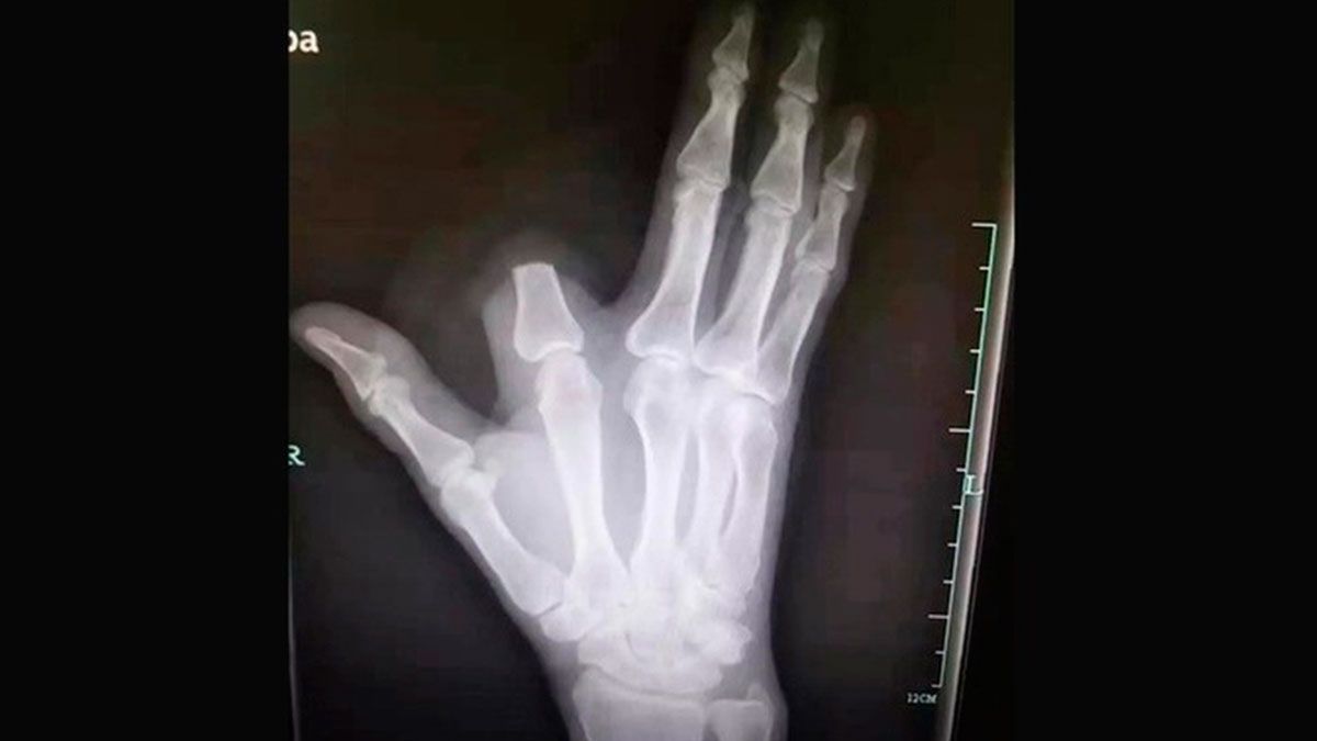 Se amputa dedo por mordida de serpiente y no era necesario