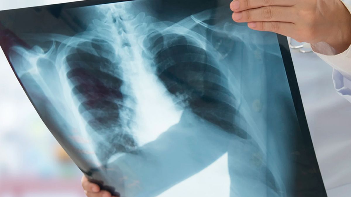 Tuberculosis: una de las 10 principales causas de muerte en el mundo