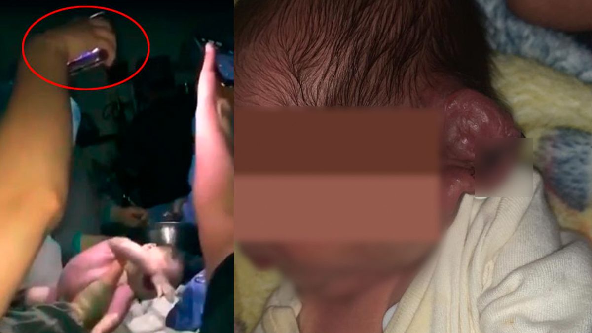 Cortan oreja a bebé durante cesárea en Baja California