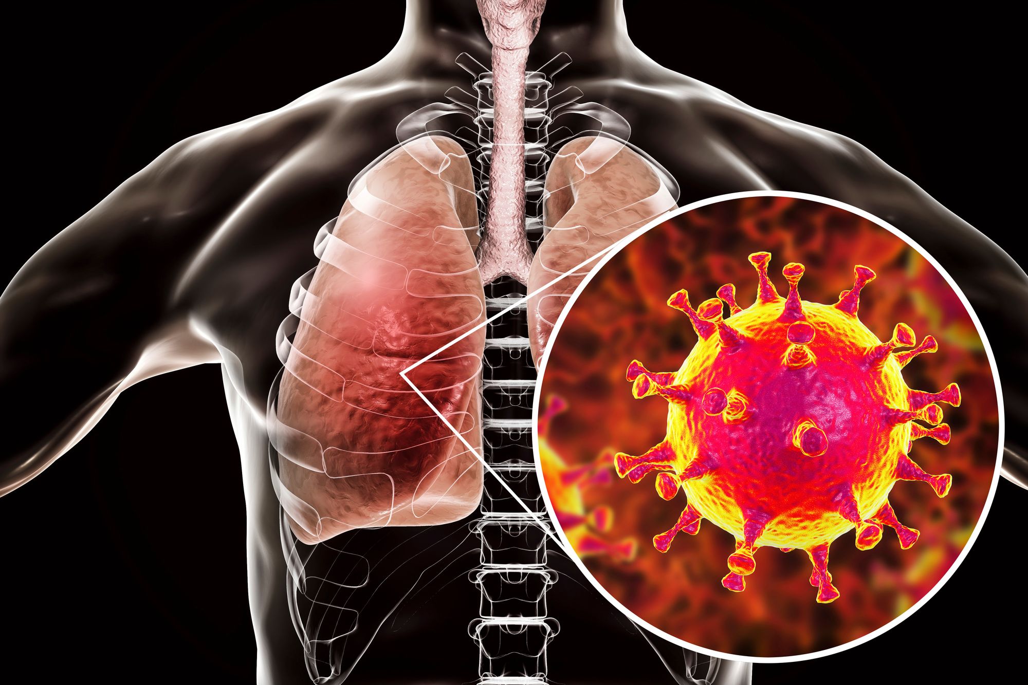 Middle East Respiratory Syndrome (MERS) - Naugatuck Valley Health District